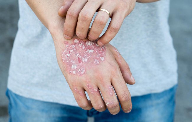 How Your Diet Can Make Your Psoriasis Symptoms Worse—And What To Do About It